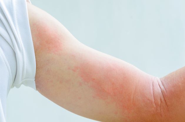 what Causes hives